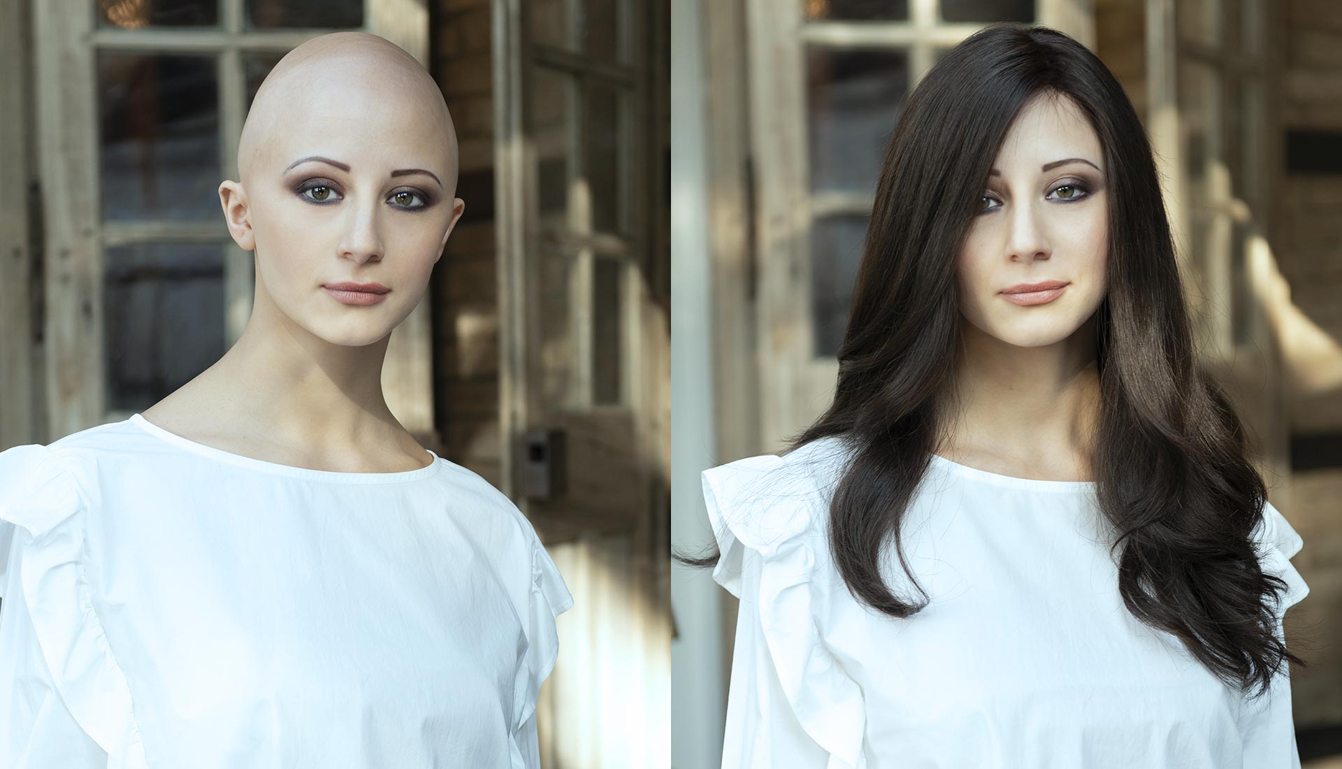 alopecia e scelta della parrucca