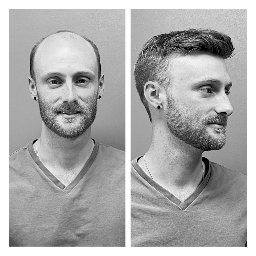 soluzioni per calvizie uomo