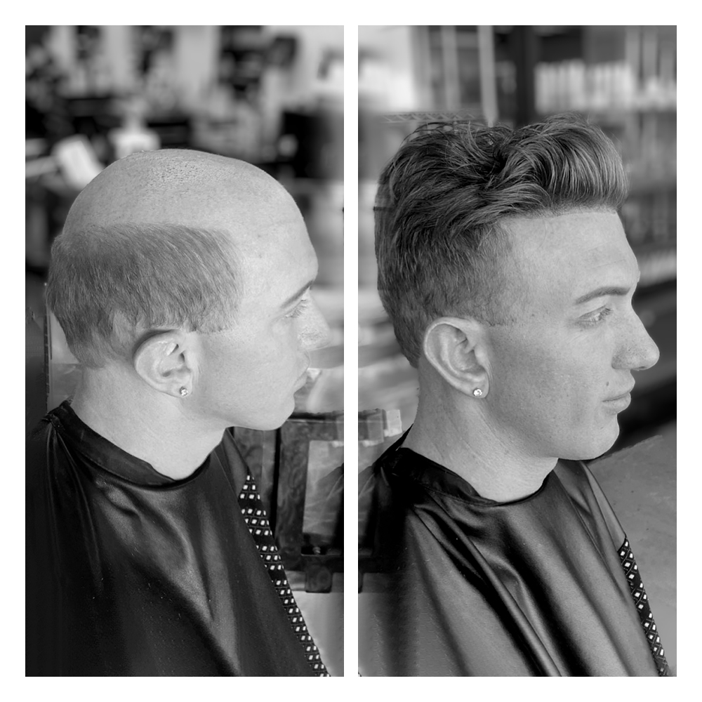 soluzioni per calvizie uomo