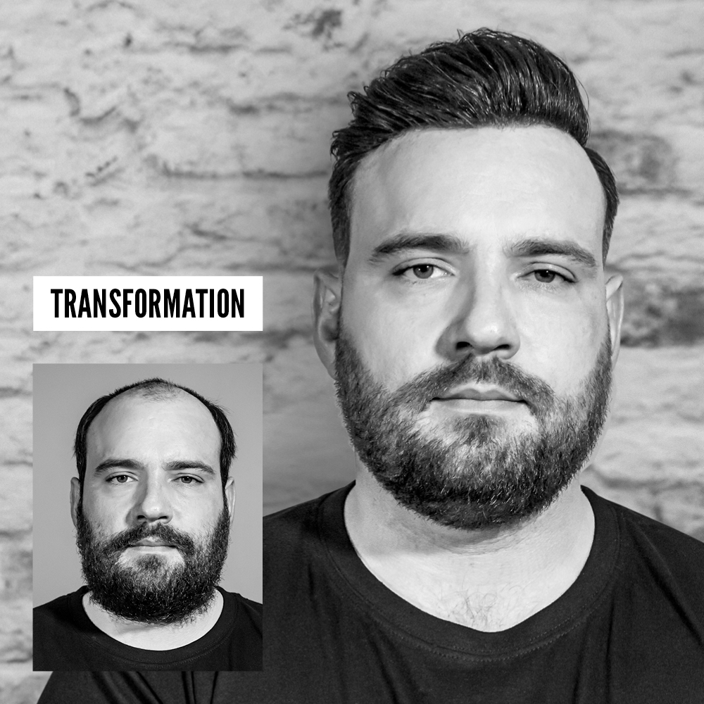 soluzioni per calvizie uomo