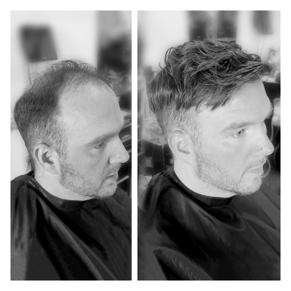 soluzioni per calvizie uomo