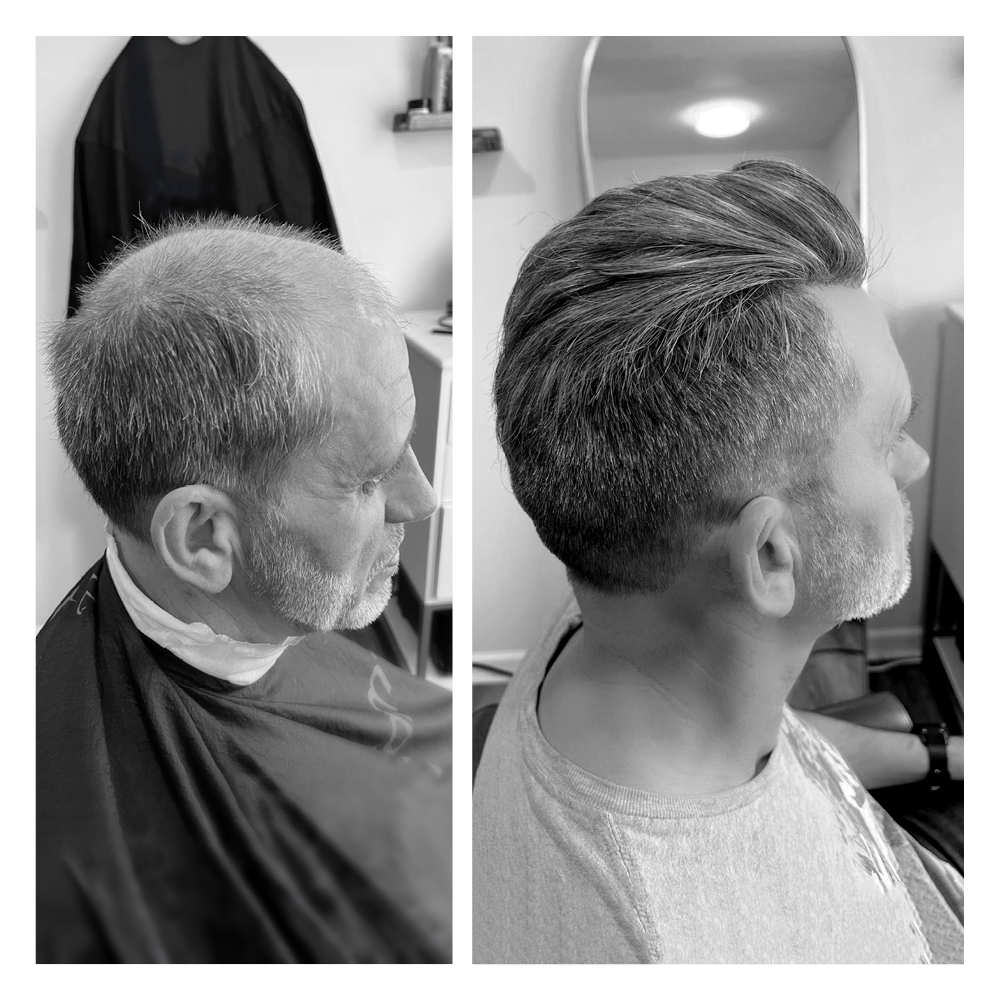 soluzioni per calvizie uomo