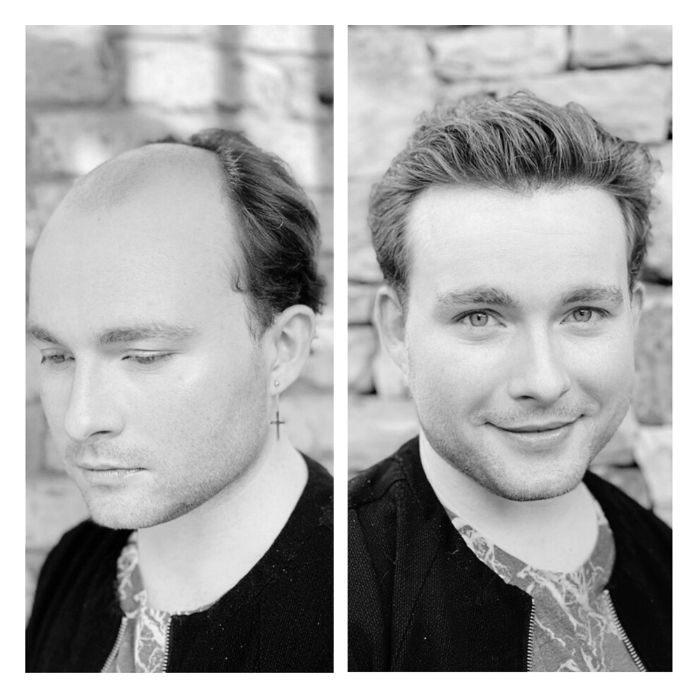 soluzioni per calvizie uomo