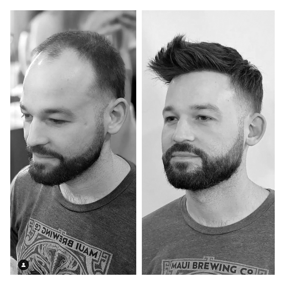 soluzioni per calvizie uomo