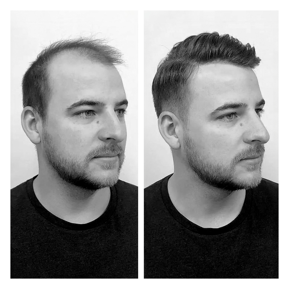 soluzioni per calvizie uomo