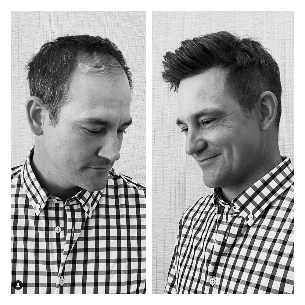 soluzioni per calvizie uomo