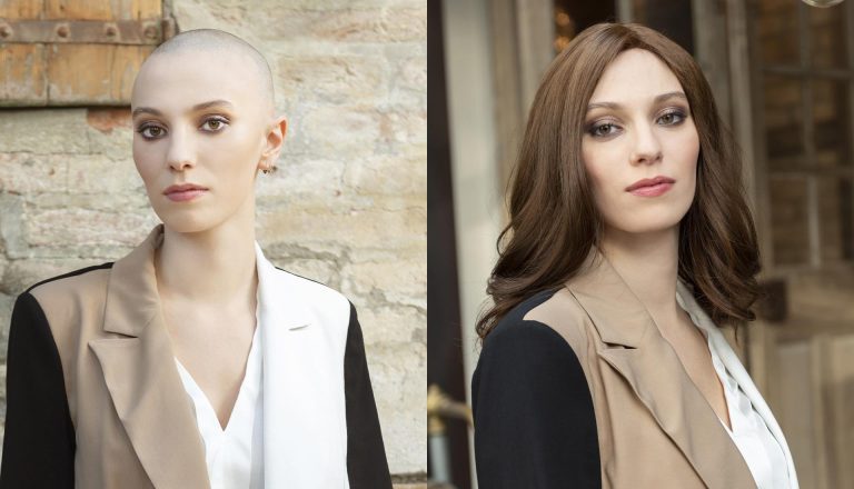 alopecia e parrucca