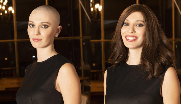 alopecia e parrucca
