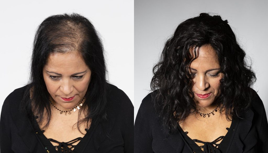 soluzione al diradamento capelli
