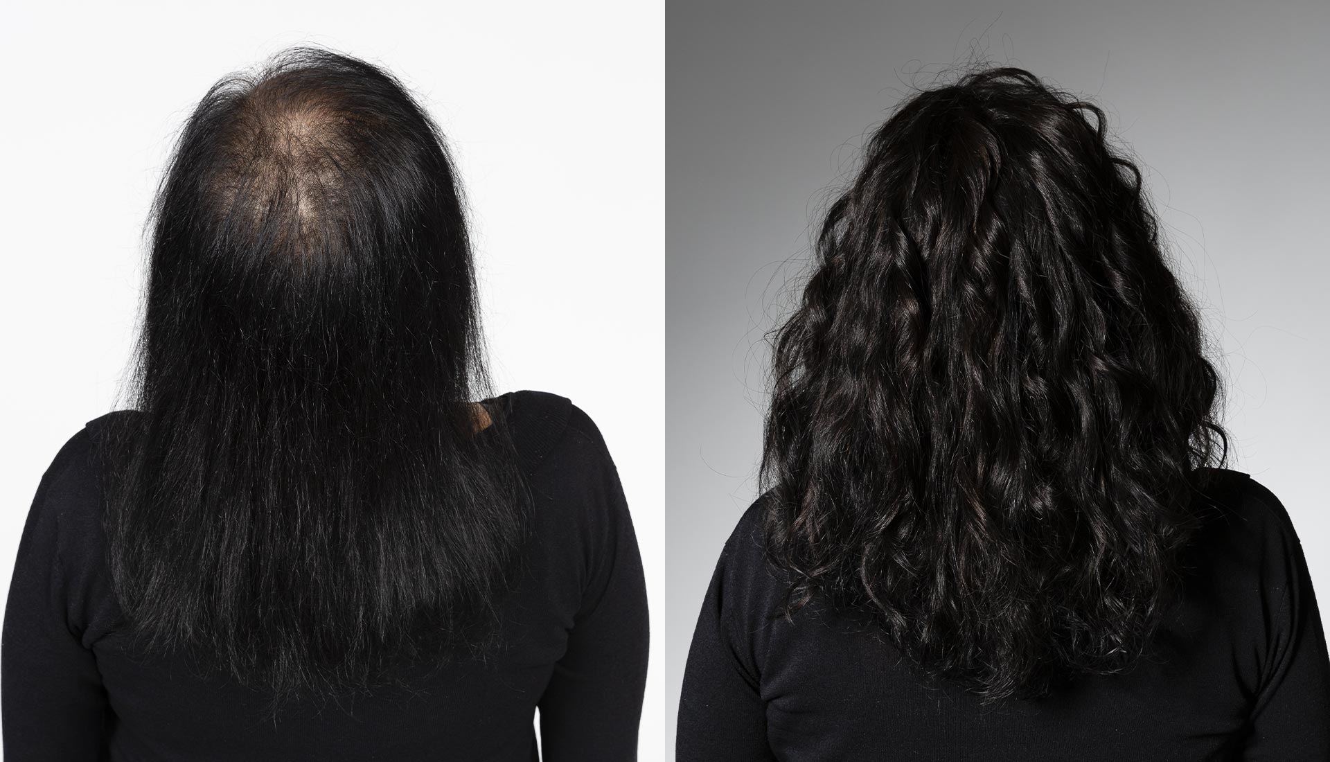 soluzione al diradamento capelli
