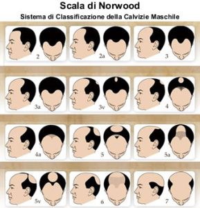 infoltimento capelli uomo