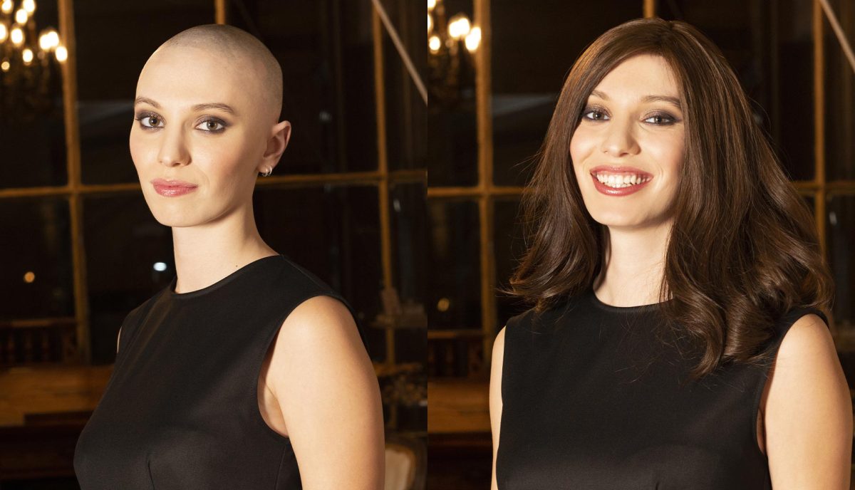 alopecia e parrucca